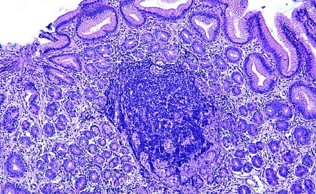 Gastrite folliculaire LAPVSO